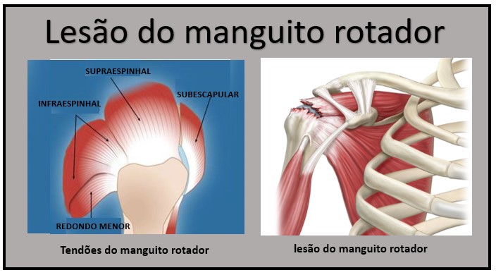 5 Exercícios Essenciais para Fortalecer o Manguito Rotador em Casa