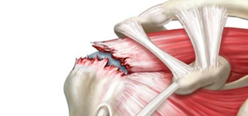 Entenda os Estágios da Ruptura do Manguito Rotador