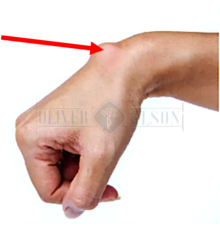 Suplementos Naturais que Combatem a Artrite no Pulso