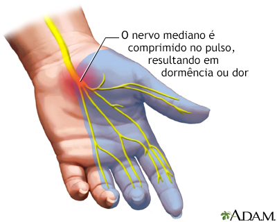 Quando a Cirurgia é a Melhor Opção para Artrite no Pulso