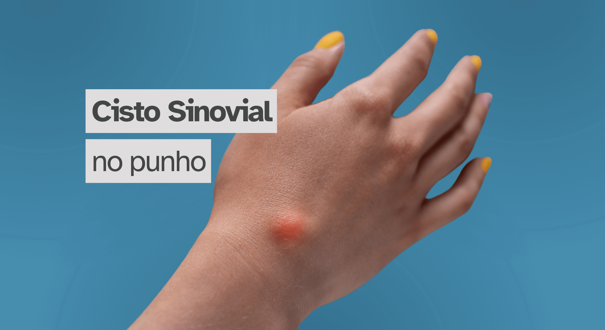 Recuperação Pós-Cirurgia de Cisto Sinovial