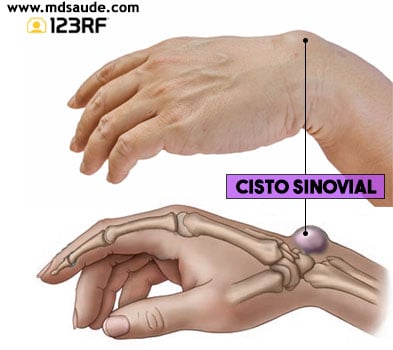 Exercícios para Cisto Sinovial