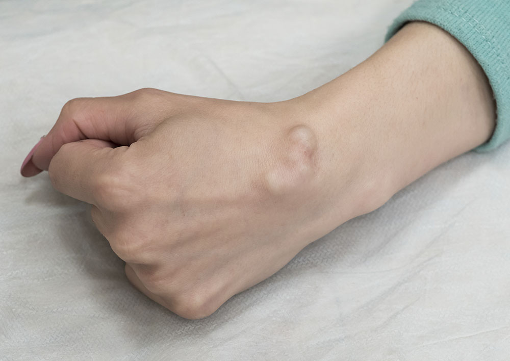 Recuperação Pós-Cirurgia de Cisto Sinovial