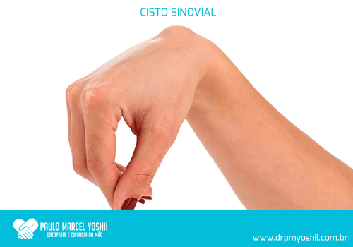 Exercícios para Cisto Sinovial