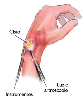 Como tratar a dor no pulso por cisto sinovial
