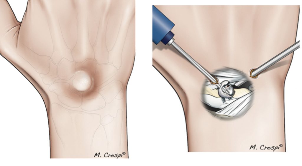 O que é um Cisto Sinovial?