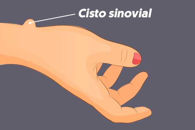 Prevenção de Cistos Sinoviais