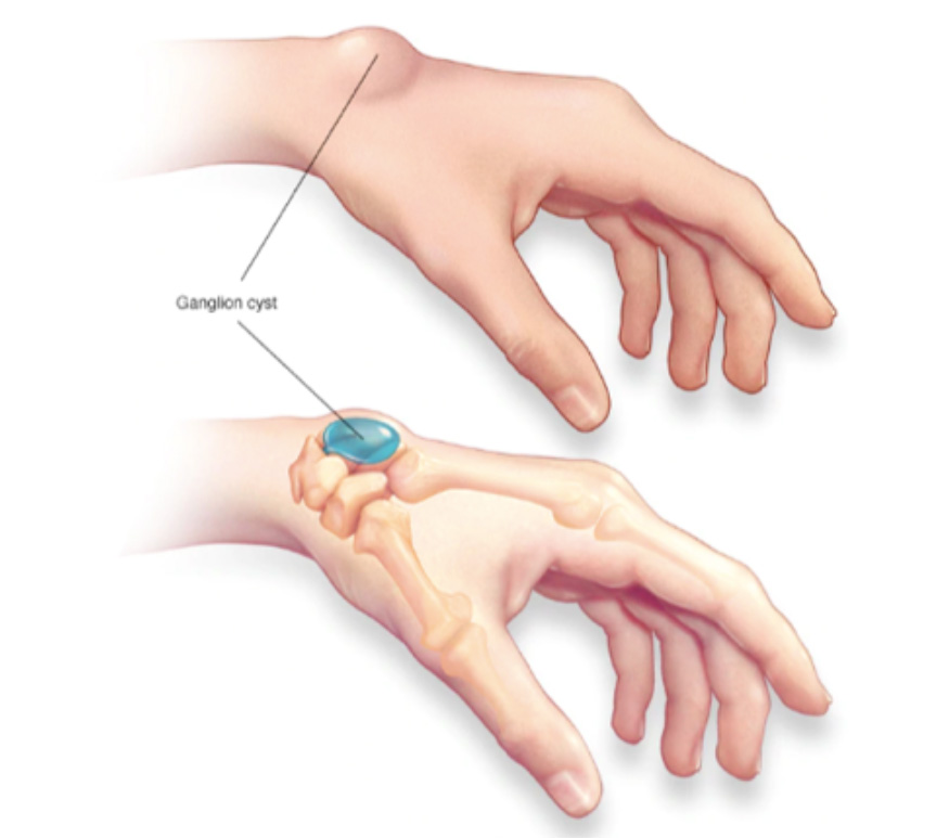 Como tratar a dor no pulso por cisto sinovial e tendinite
