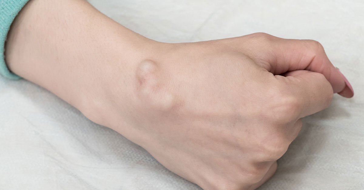 Como tratar a dor no pulso por cisto sinovial e tendinite