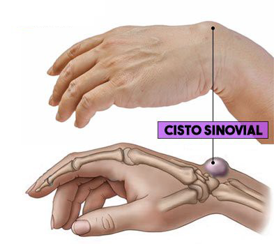 Como tratar a dor no pulso por cisto sinovial e tendinite