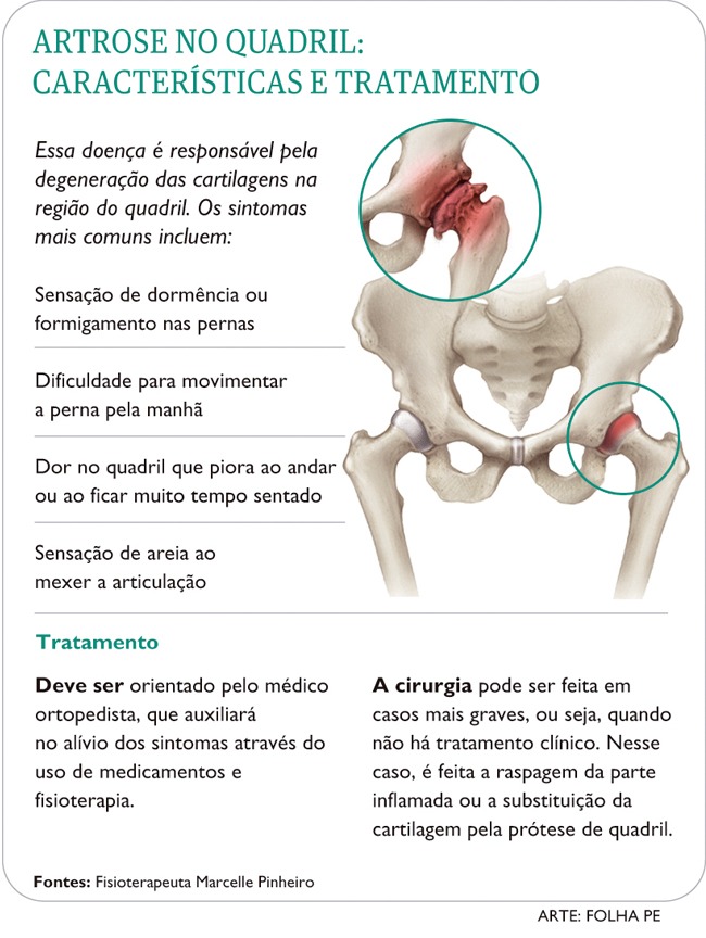 Exercícios de Baixo Impacto para Artrose no Quadril