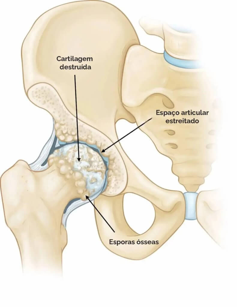 A Importância do Controle de Peso no Tratamento da Artrose