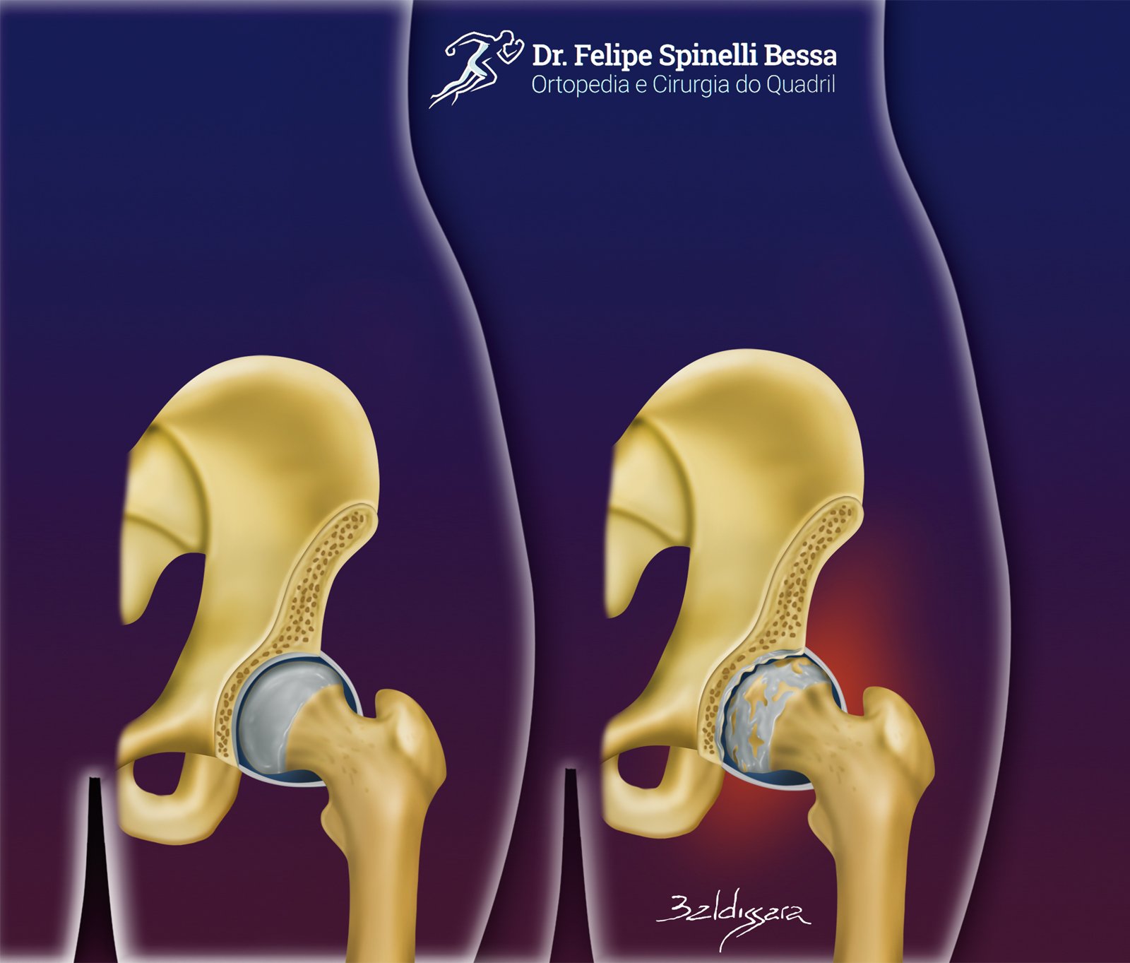 Quando Considerar a Prótese de Quadril?