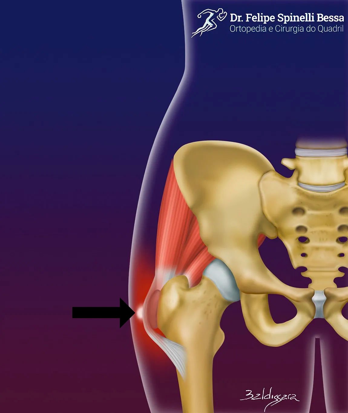 Diferença entre Bursite e Tendinite no Quadril
