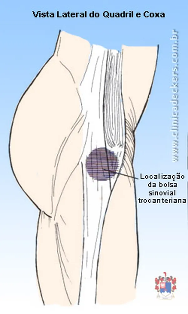 Como Dormir com Dor no Quadril Causada por Bursite