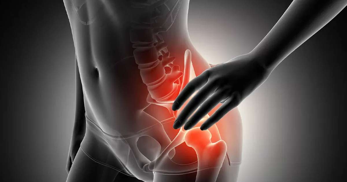 Diferença entre Bursite e Tendinite no Quadril