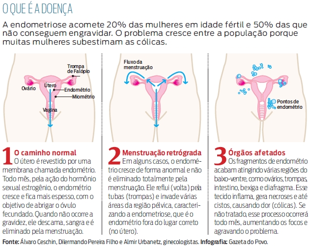 Como tratar a endometriose
