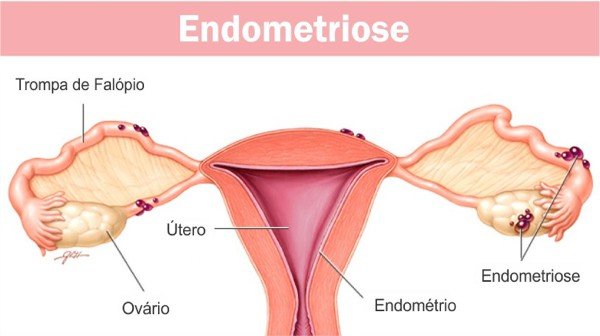 Como a Fisioterapia Pélvica Ajuda no Alívio da Dor da Endometriose