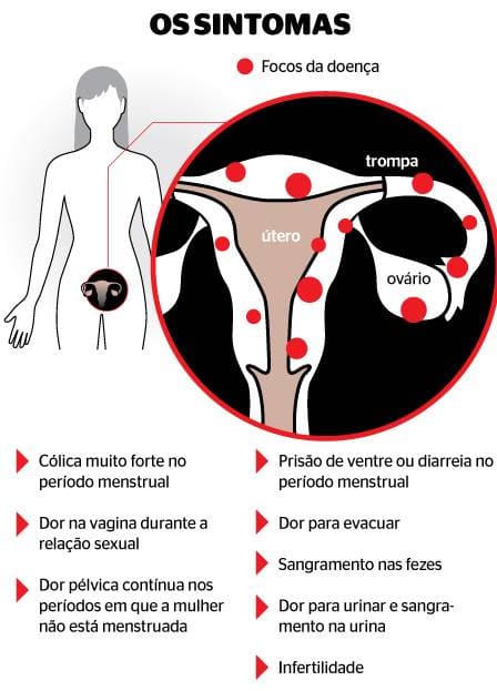 Guia Completo da Laparoscopia no Tratamento da Endometriose