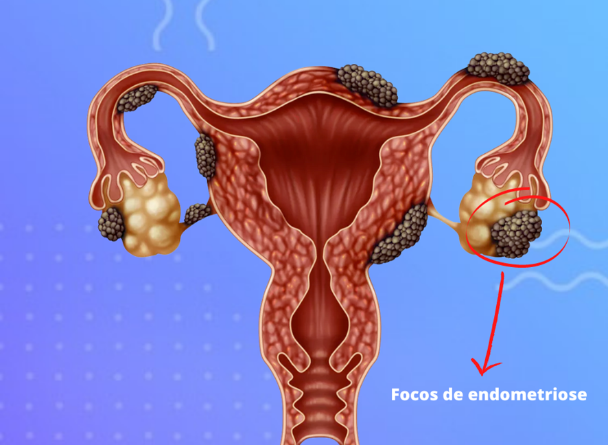 O Papel da Vitamina B12 e Ácido Fólico no Manejo da Endometriose