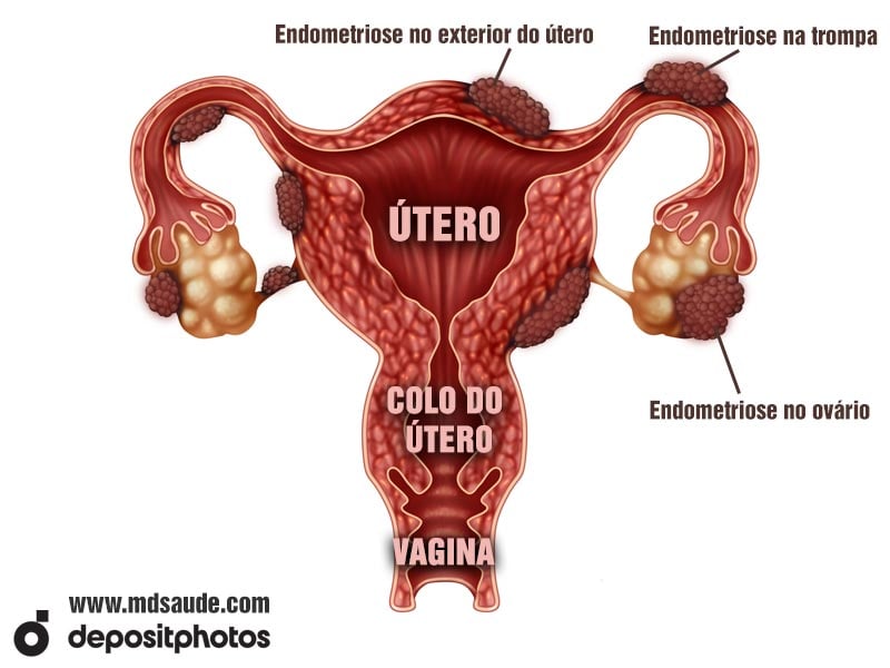10 Alimentos Anti-inflamatórios para Combater a Endometriose