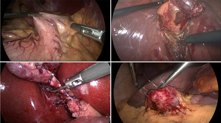 Como a Fisioterapia Pélvica Ajuda no Alívio da Dor da Endometriose