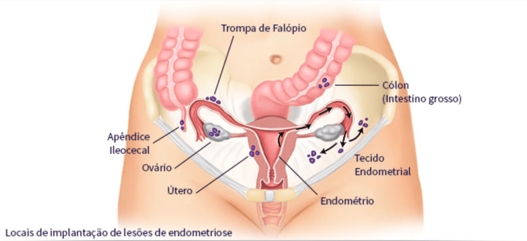 Entenda os Diferentes Tipos de Tratamento Hormonal para Endometriose
