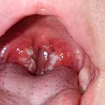 Faringite Viral vs. Bacteriana: Entenda as Diferenças