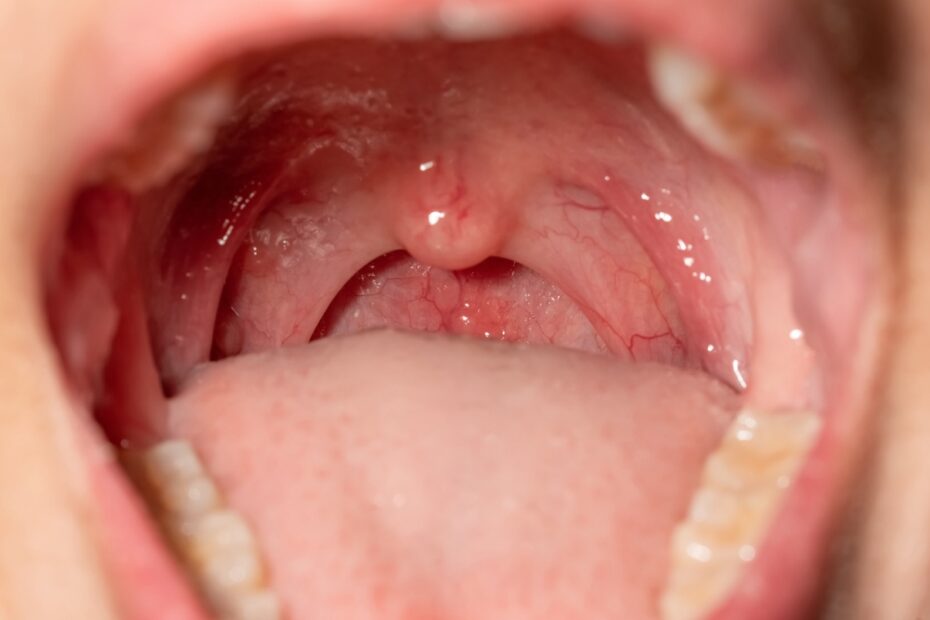 Quando Procurar um Médico para Dor de Garganta