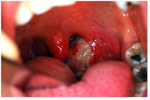 Prevenção da Faringite: Dicas para Evitar a Infecção