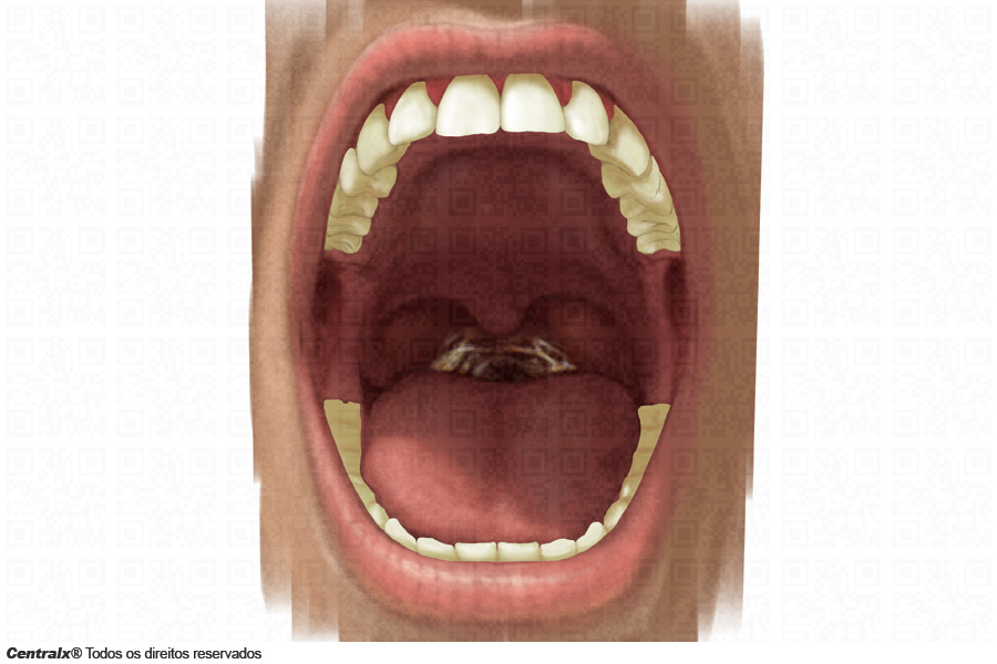 5 Remédios Caseiros Eficazes para Dor de Garganta