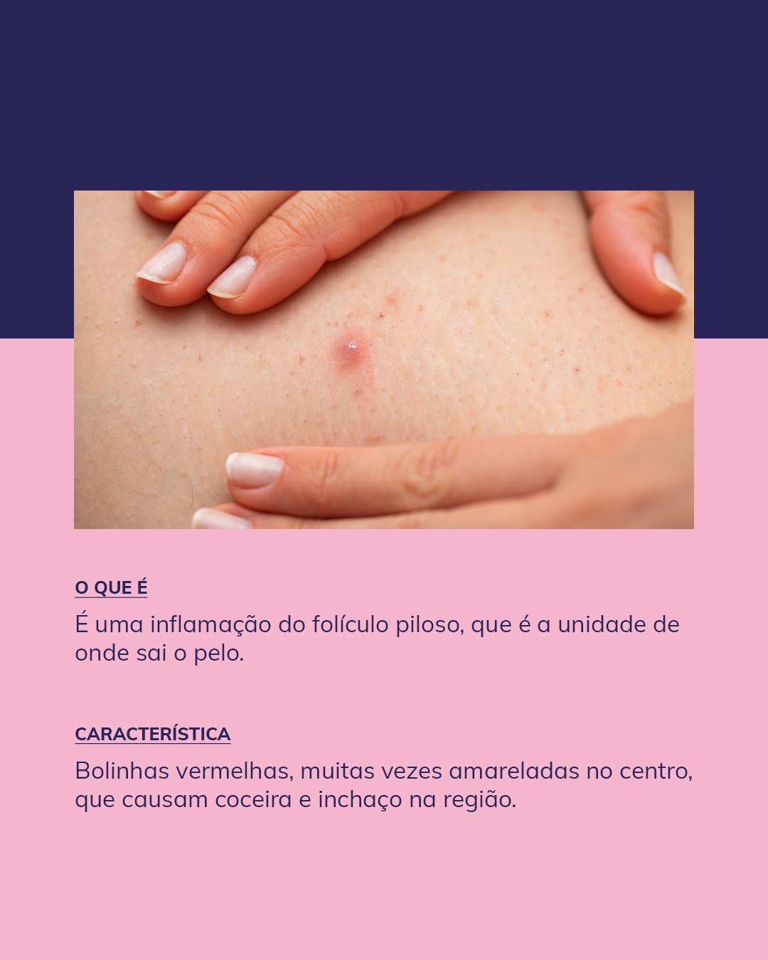 5 Dicas Essenciais para Prevenir a Foliculite