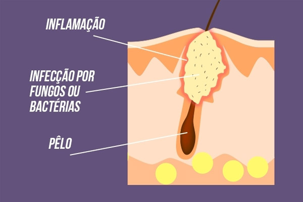 Alimentação e Foliculite: Mitos e Verdades