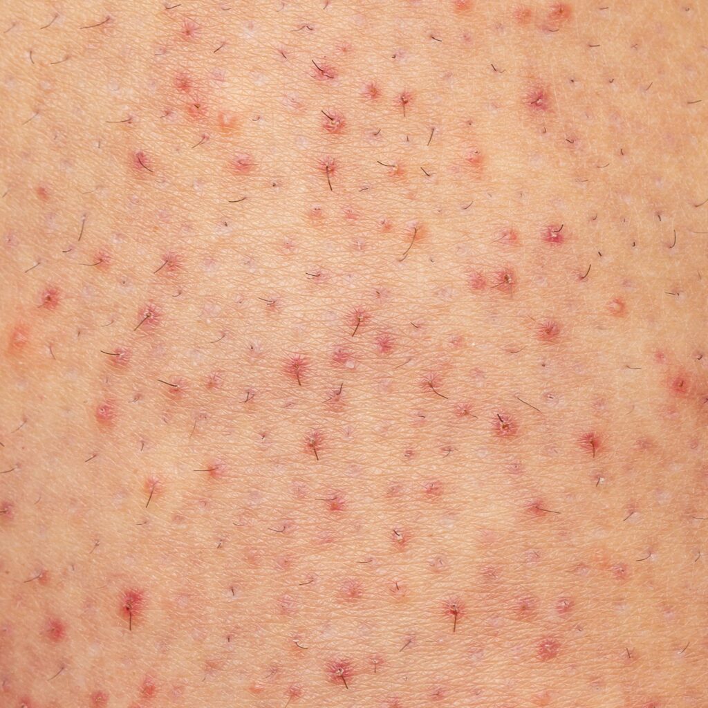 Como tratar a foliculite