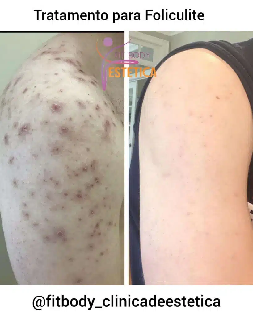 5 Dicas Essenciais para Prevenir a Foliculite