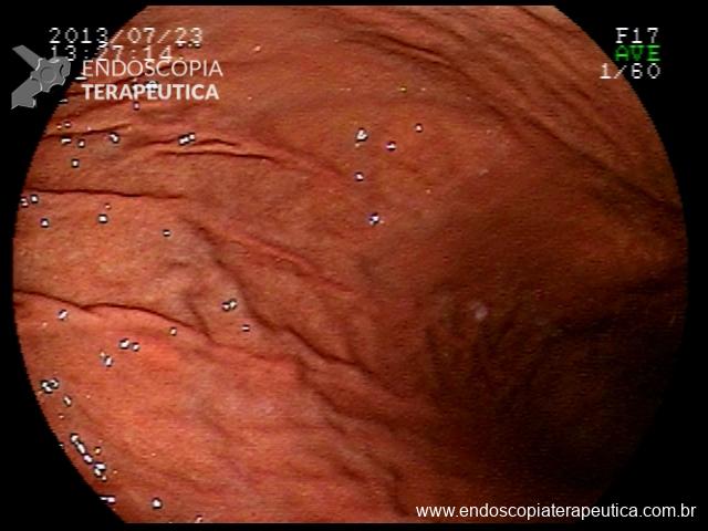Como a Bactéria H. pylori Causa Gastrite Atrófica?