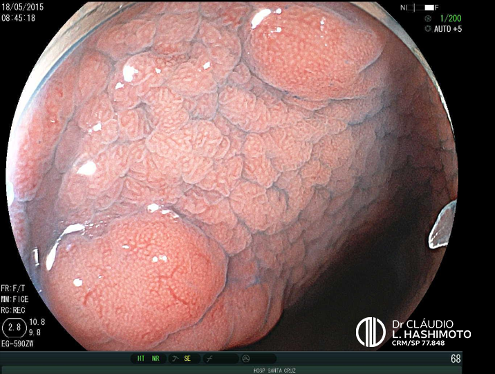 A Importância da Vitamina B12 no Tratamento da Gastrite Atrófica