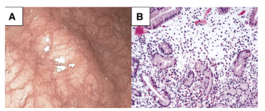O que é Gastrite Atrófica Autoimune?