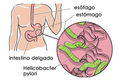 Diferenças entre Pyloripac e H.Bacter IBP