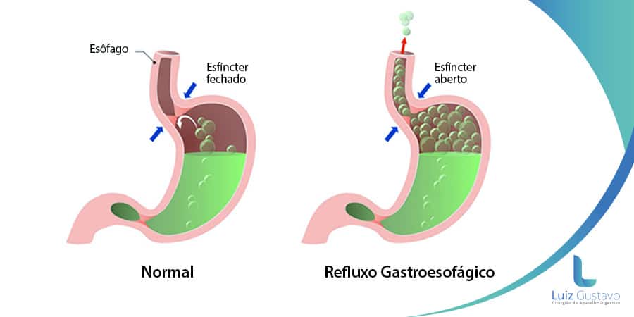 Como tratar a gastrite por refluxo