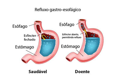 Como tratar a gastrite por refluxo biliar