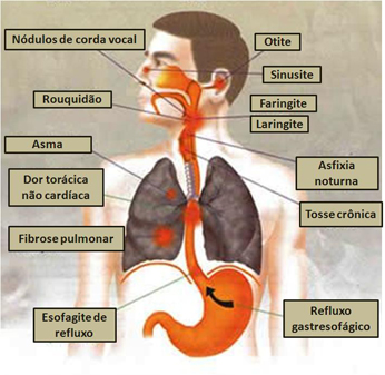 10 Alimentos que Pioram o Refluxo Biliar