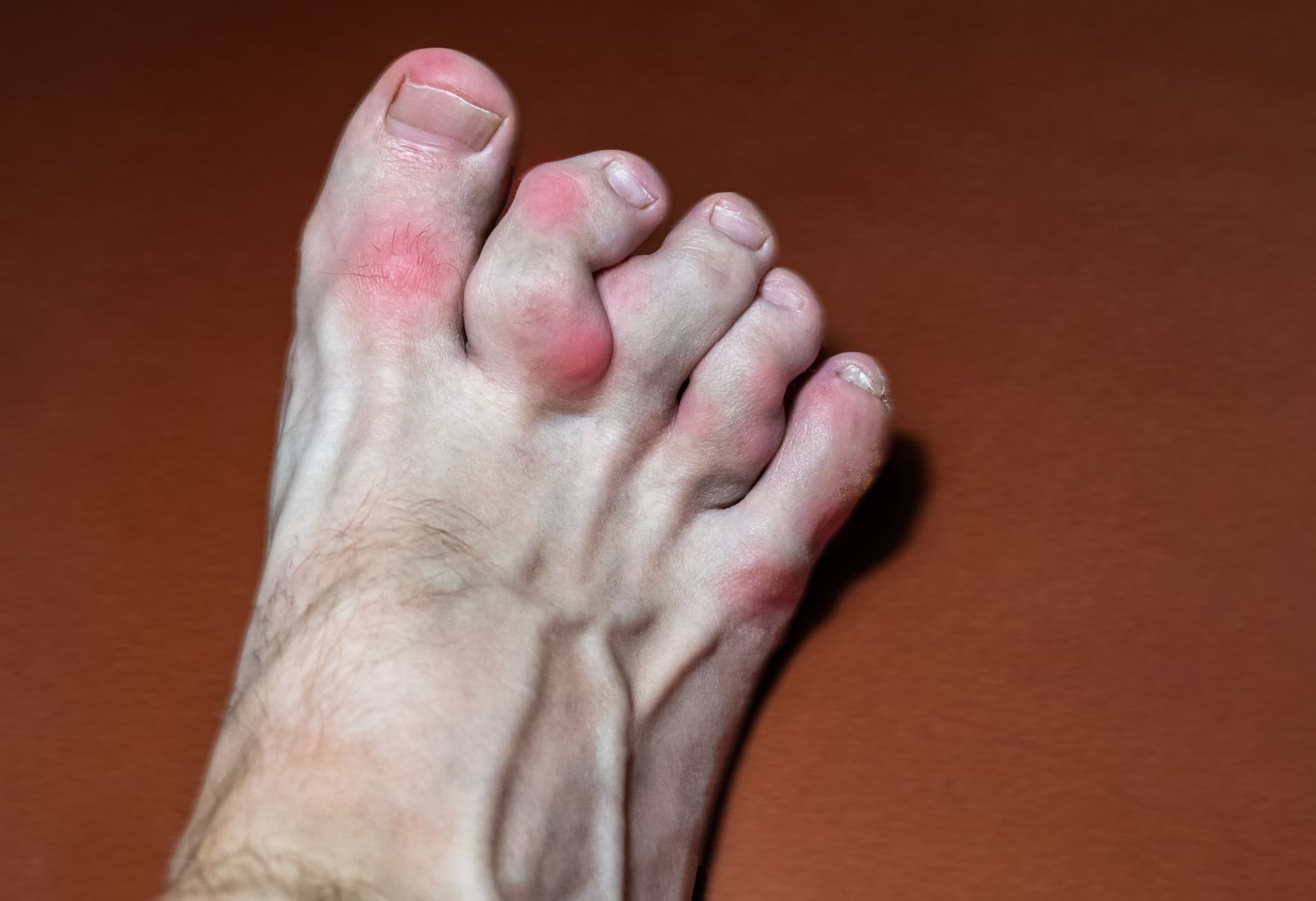 Os Melhores Remédios Caseiros para Aliviar a Dor da Gota