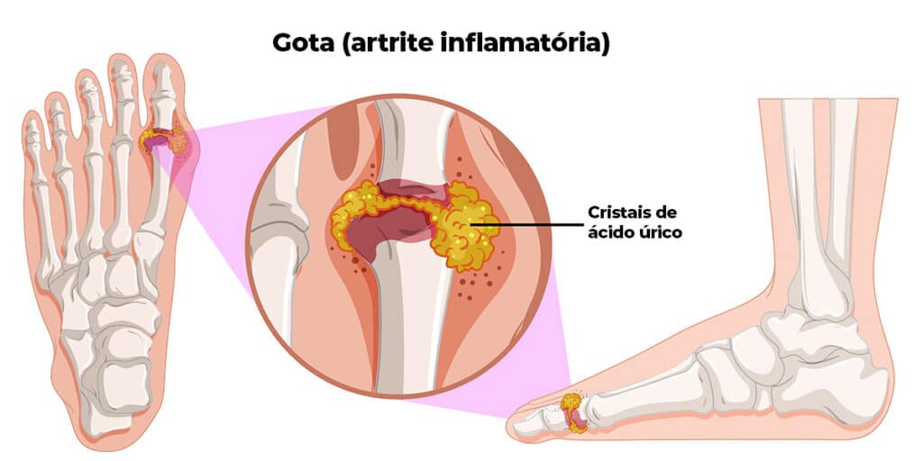 Como a Gota Afeta as Articulações: Um Guia Visual