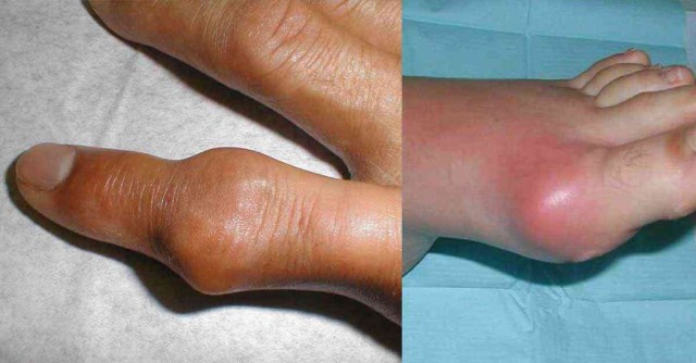 Exercícios Físicos e Gota: O Que Você Precisa Saber