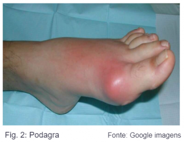 Guia Completo de Alimentos Permitidos e Proibidos para Gota