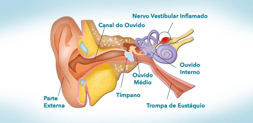 Como tratar a labirintite por problemas auditivos