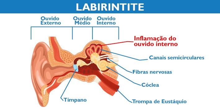 Como tratar a labirintite viral