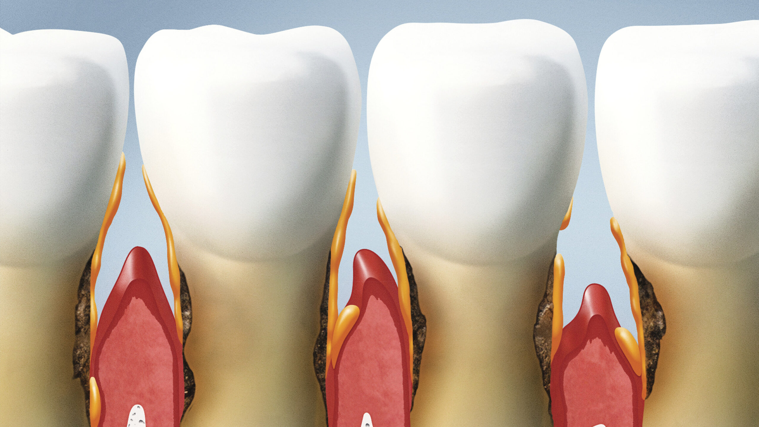 Como tratar a periodontite agressiva