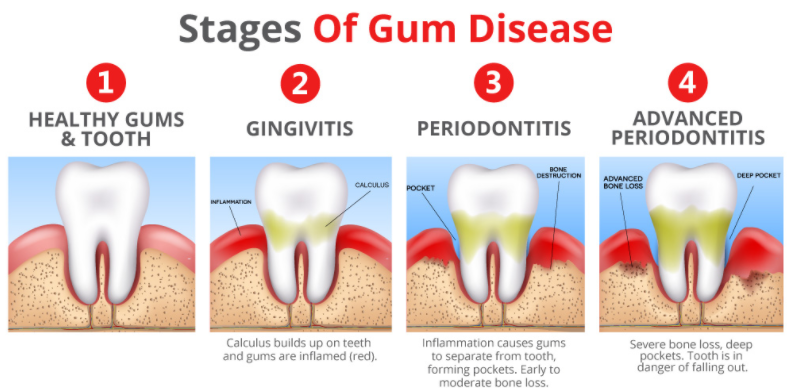 Acompanhamento Pós-Tratamento da Periodontite Agressiva: O Que Esperar?
